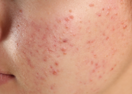 Acne