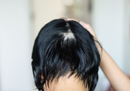 Alopecia Areata