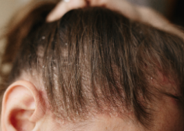 Seborrhoeic Dermatitis