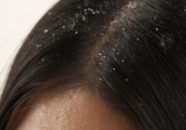 Dandruff