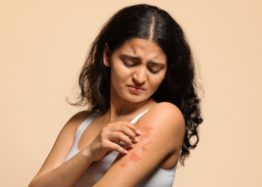 Eczema