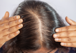 Female Pattern Baldness