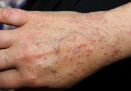 Lichen Planus