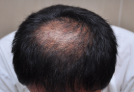Male Pattern Baldness
