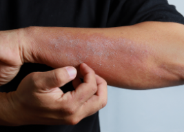 Psoriasis