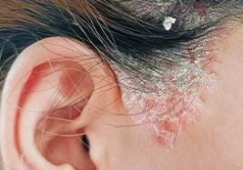 Seborrheic Dermatitis