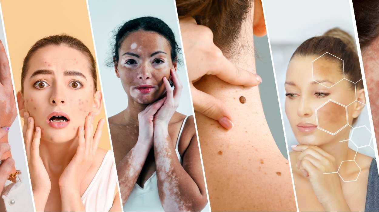 Skin Disorders