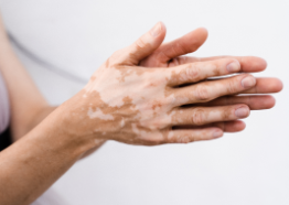 Vitiligo