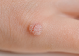 Warts